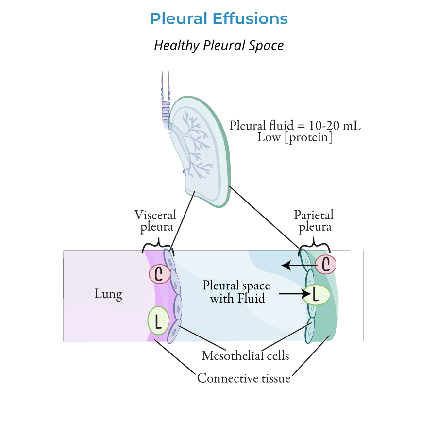 Pleural Effusions