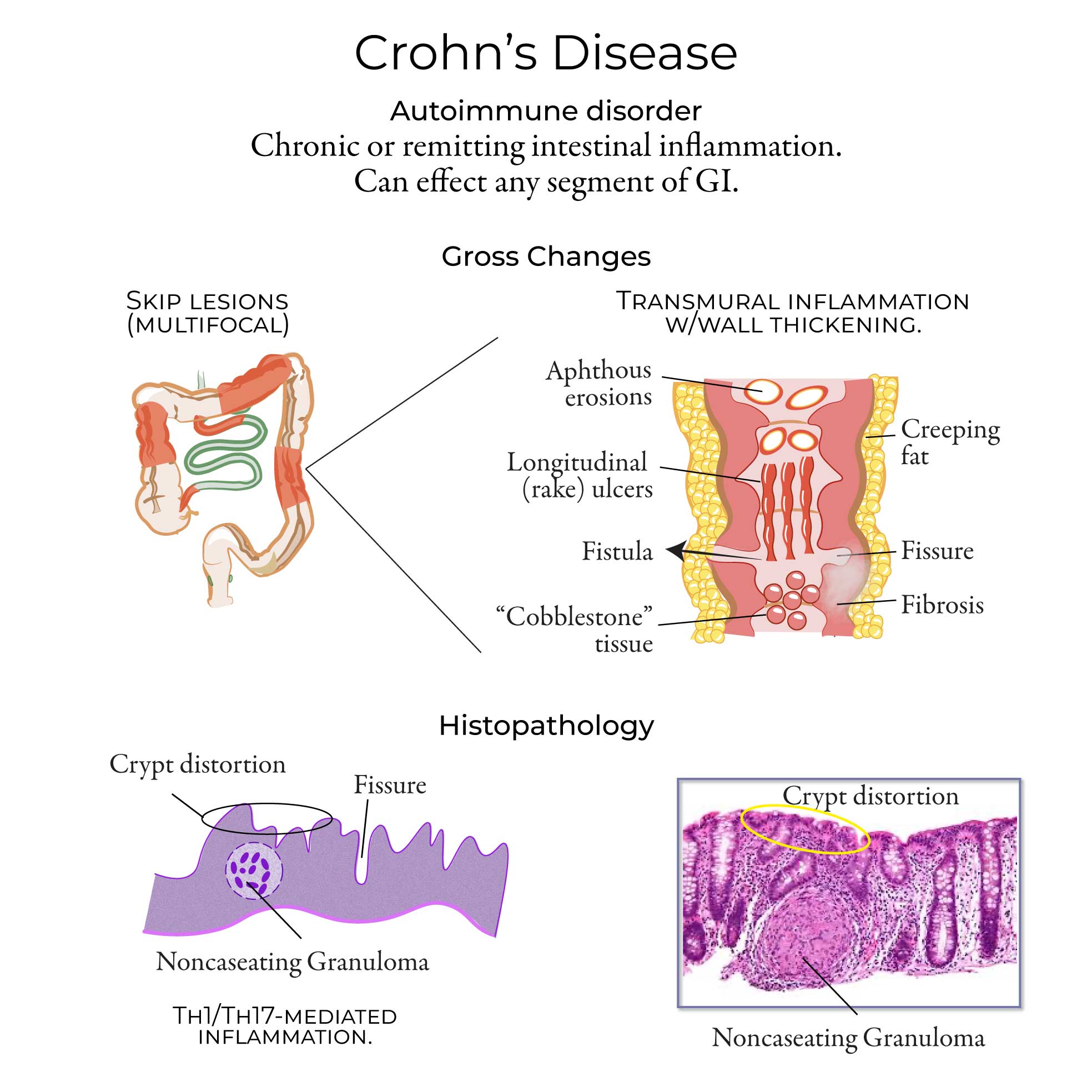 Crohn's Disease